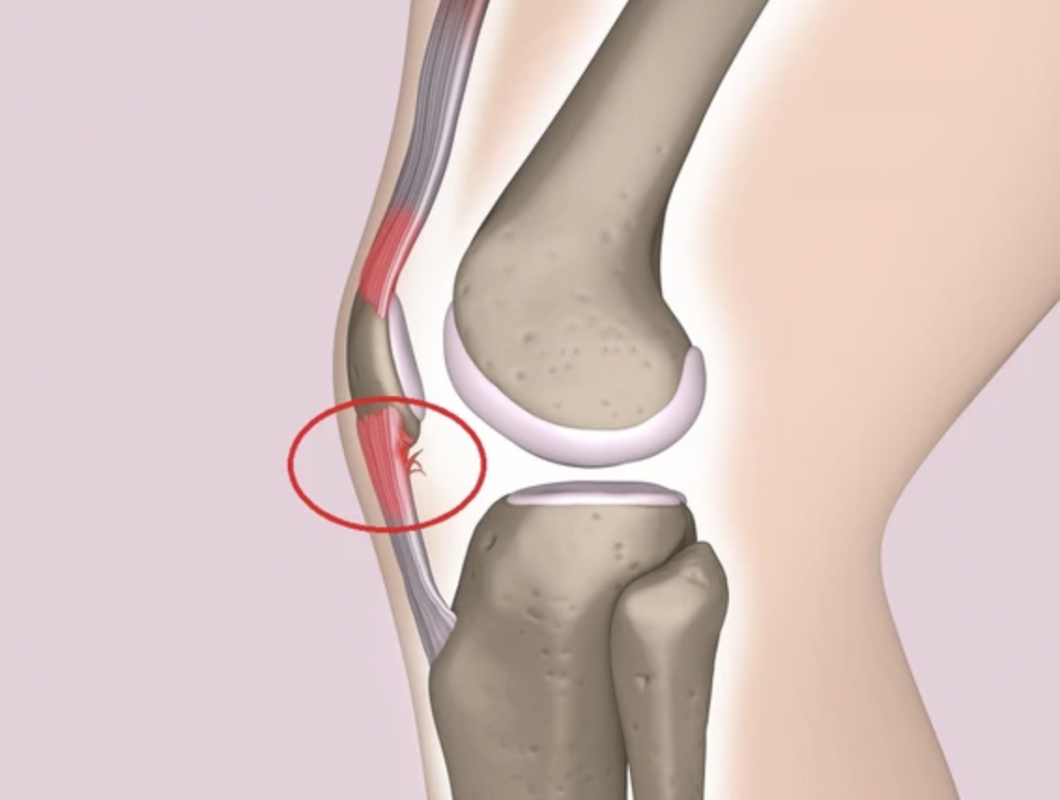 Treating Jumper’s Knee With Shockwave Therapy Treating Jumper’s Knee With Shockwave Therapy