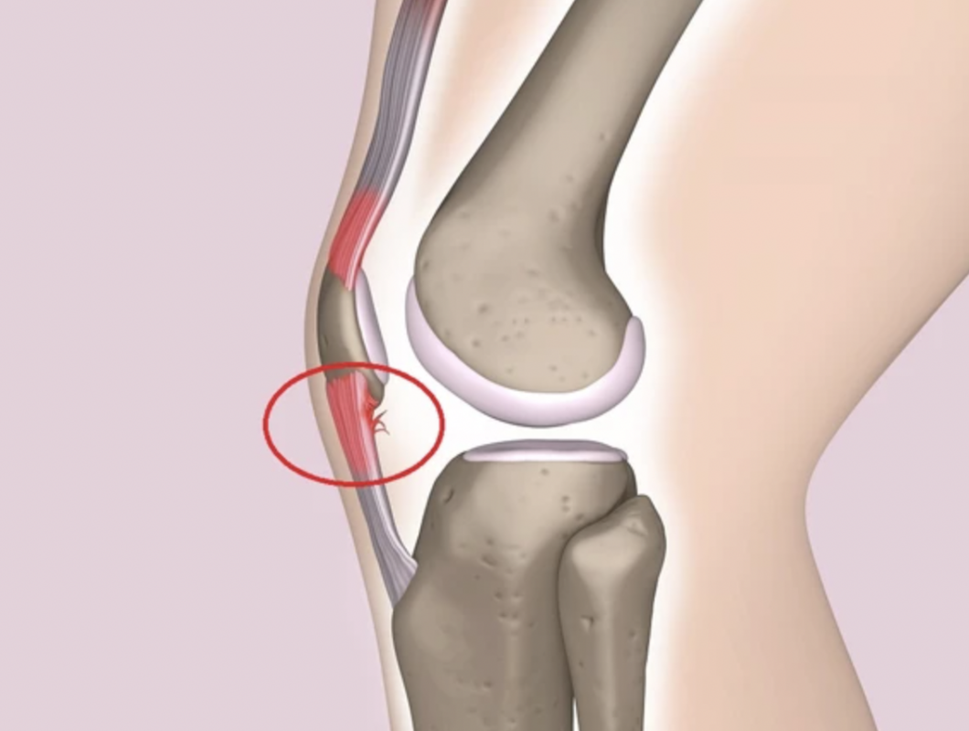 Treating Jumper’s Knee With Shockwave Therapy