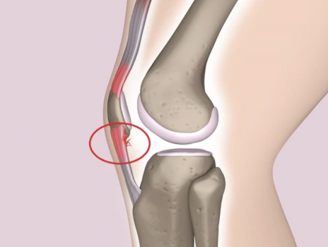 Treating Jumper’s Knee With Shockwave Therapy