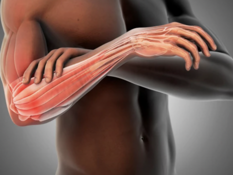 Treating Tennis Elbow With Shockwave Therapy